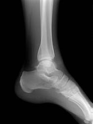 Osteoporóza - čo je to a koho ohrozuje