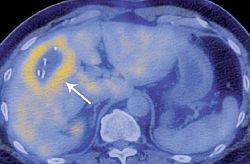Hepatitída