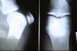 Osteoporóza - ako sa zisťuje?