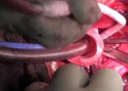 Švédski lekári prvýkrát transplantovali priedušnicu vyrobenú laboratórne