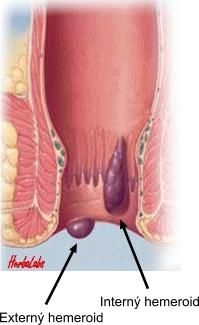 Obava z nádoru, či problém s hemeroidmi?