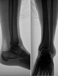 Dna (arthritis urica) - kráľovná chorôb a choroba kráľov
