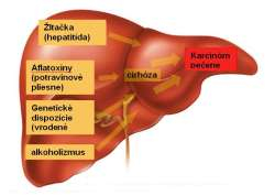 Magnetická rezonancia,  podpora a nádej pre pacientov s hepatocelulárnym karcinómom pečene (HCC)